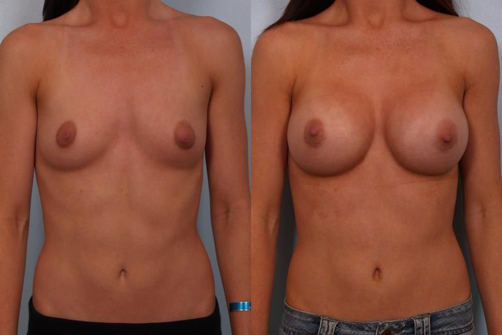 Breast Augmentation 32