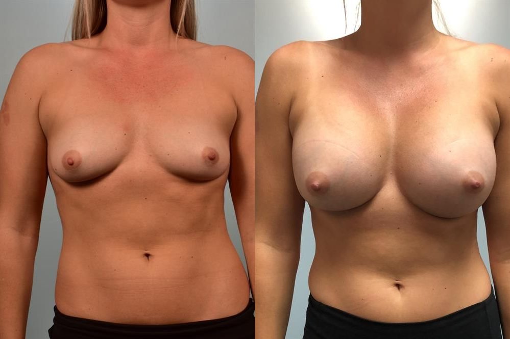 Breast Augmentation 33