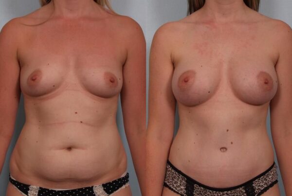 Breast Augmentation 34