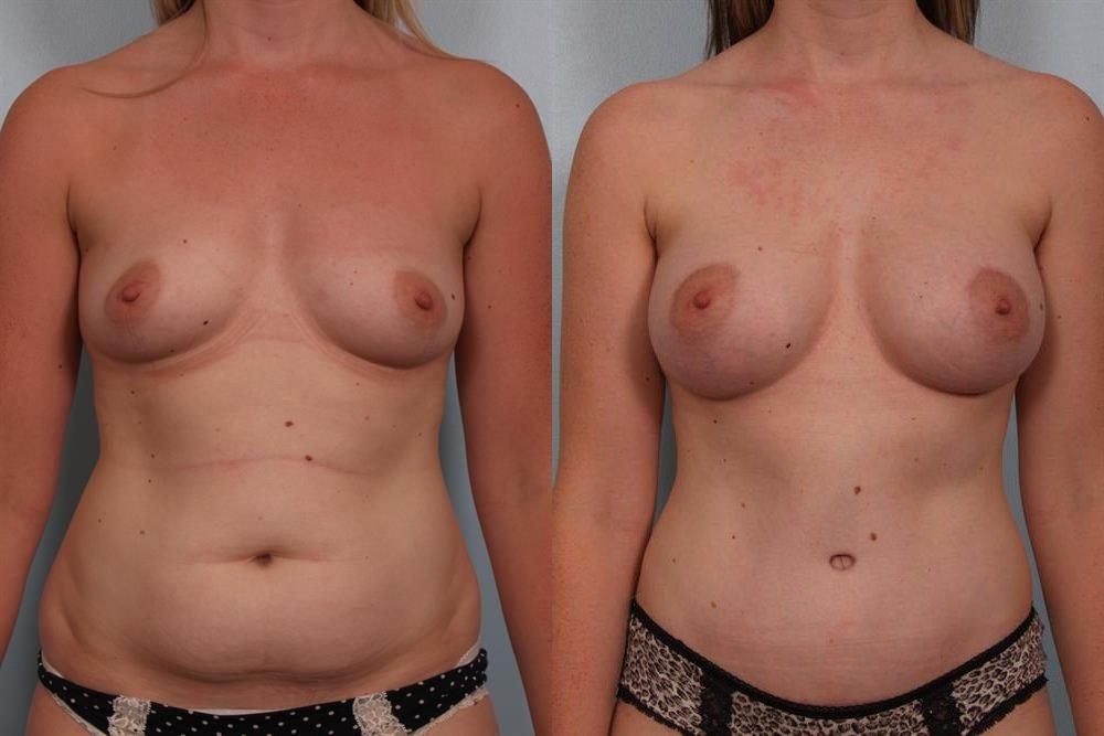 Breast Augmentation 34