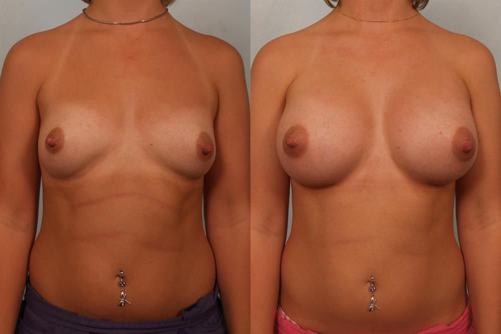 Breast Augmentation 35