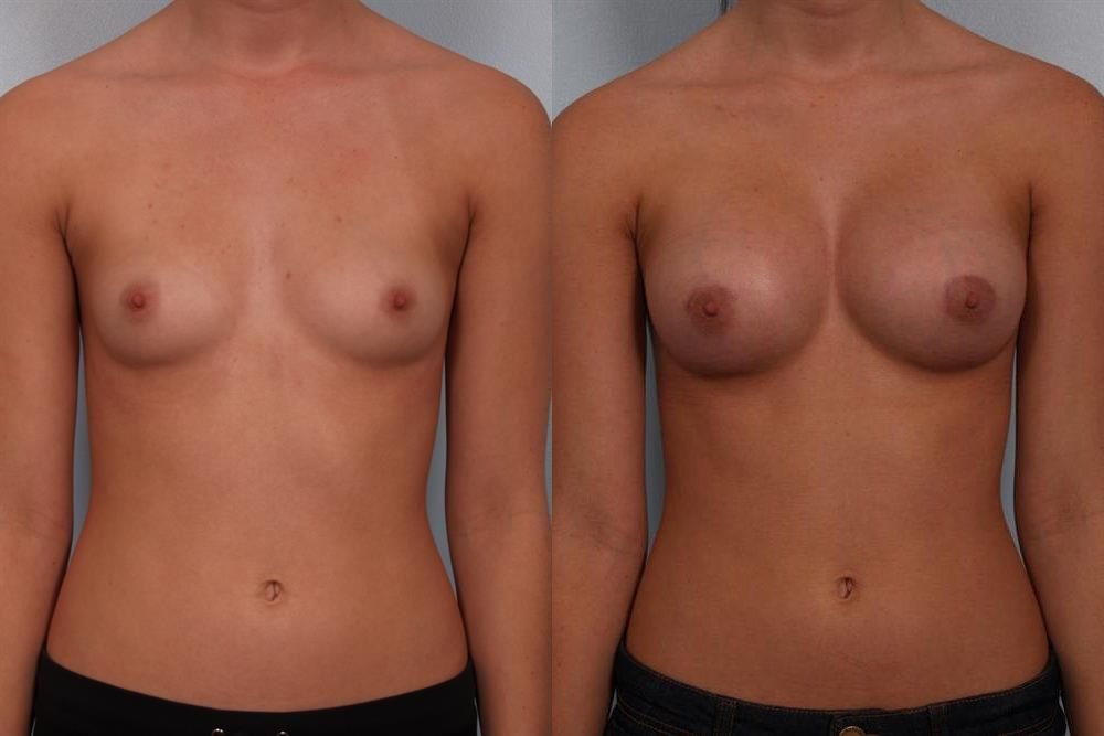 Breast Augmentation 38