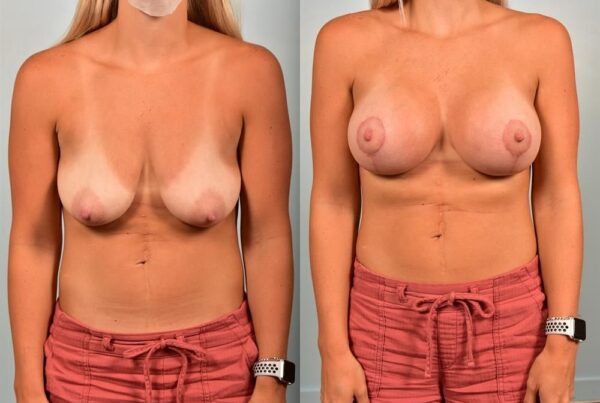 Breast Augmentation 4