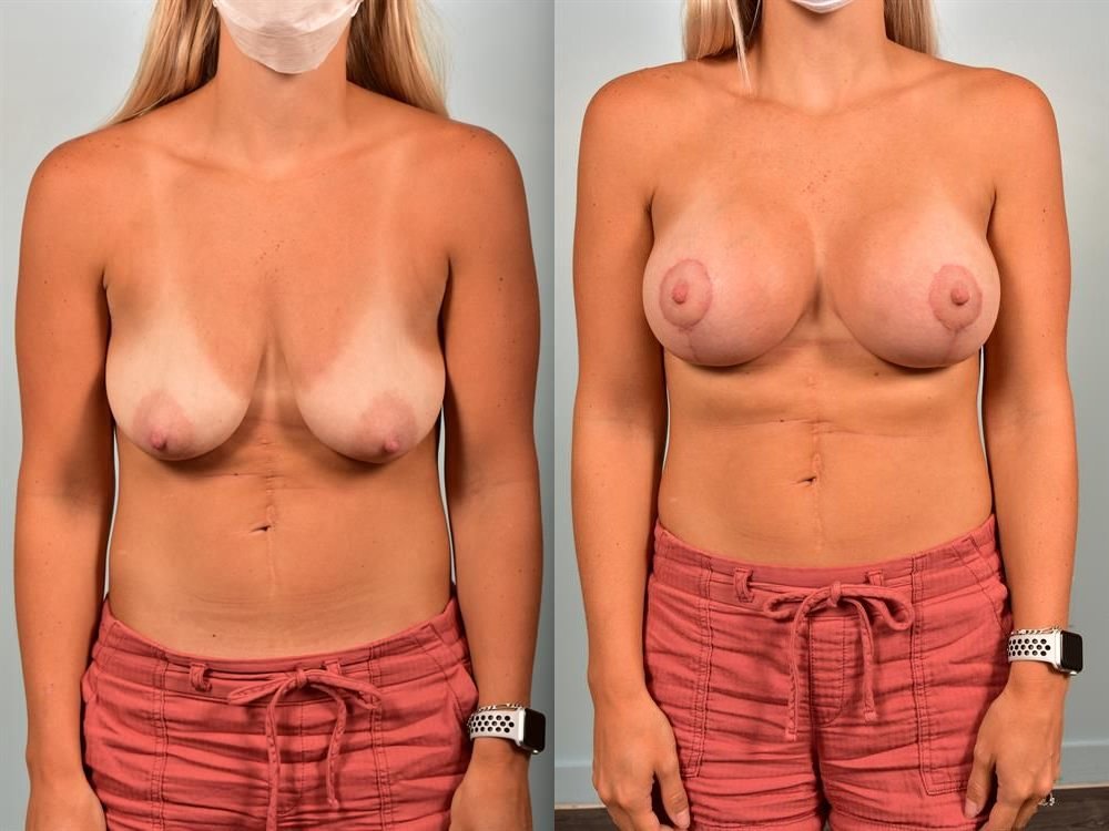 Breast Augmentation 4