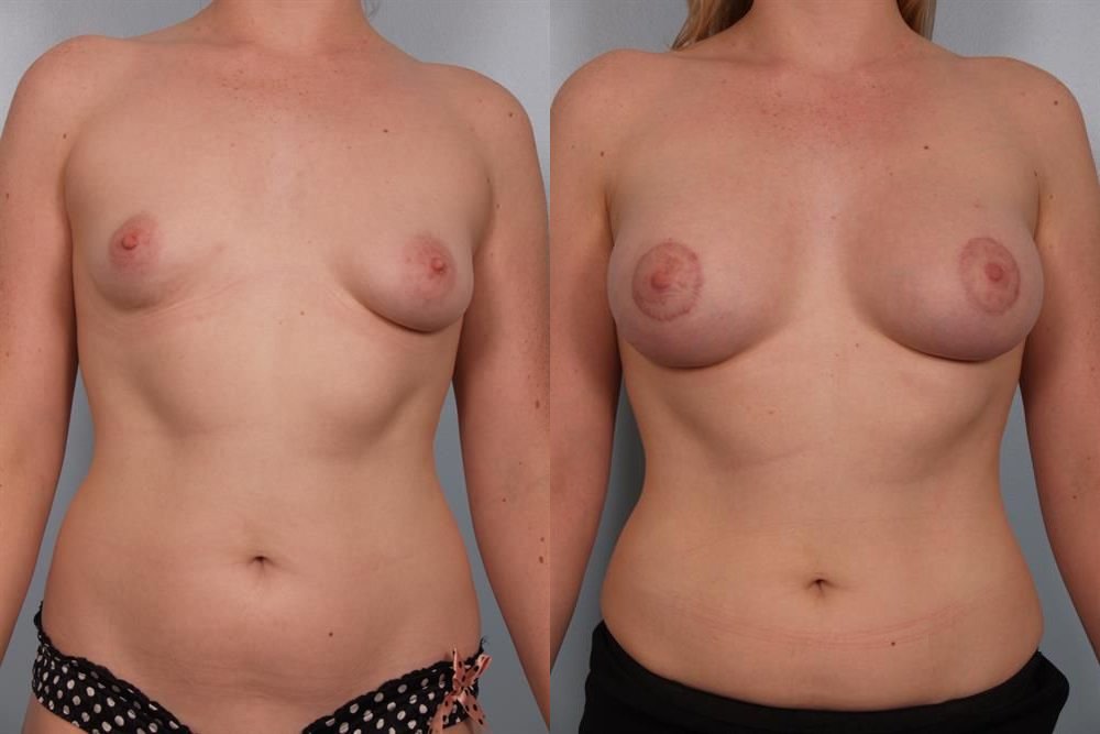 Breast Augmentation 40