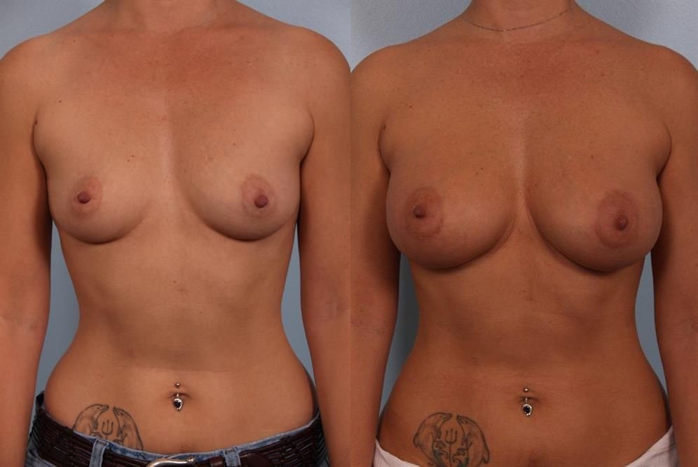 Breast Augmentation 41