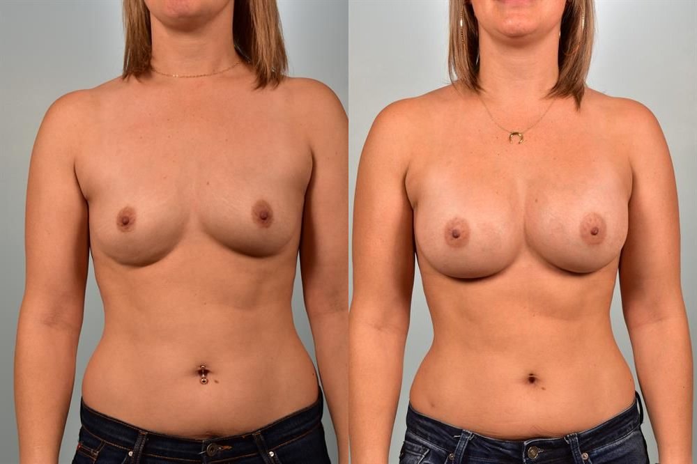 Breast Augmentation 42