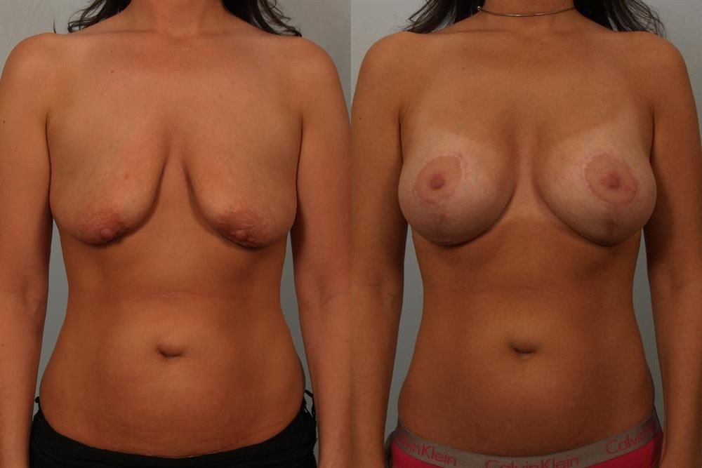 Breast Augmentation 43