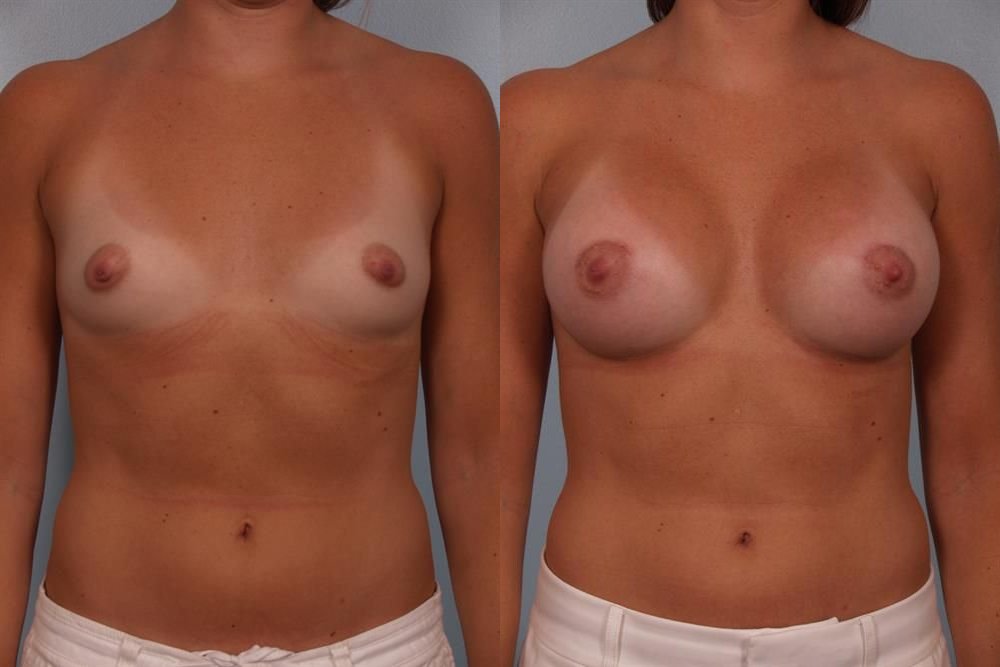 Breast Augmentation 44
