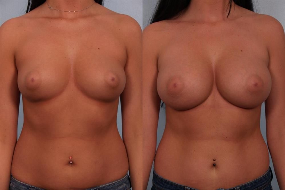 Breast Augmentation 45