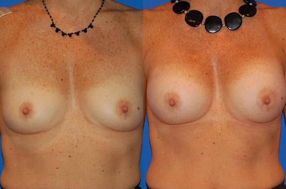 Breast Augmentation 46
