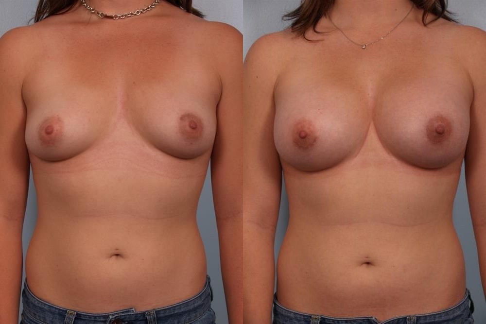 Breast Augmentation 47