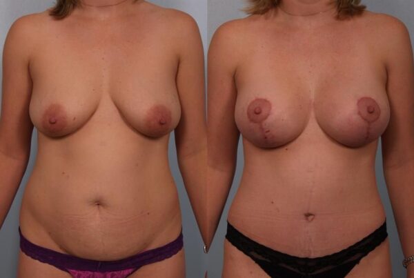 Breast Augmentation 48