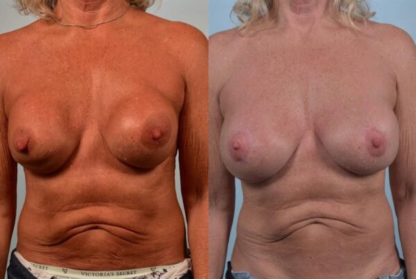 Breast Augmentation 5
