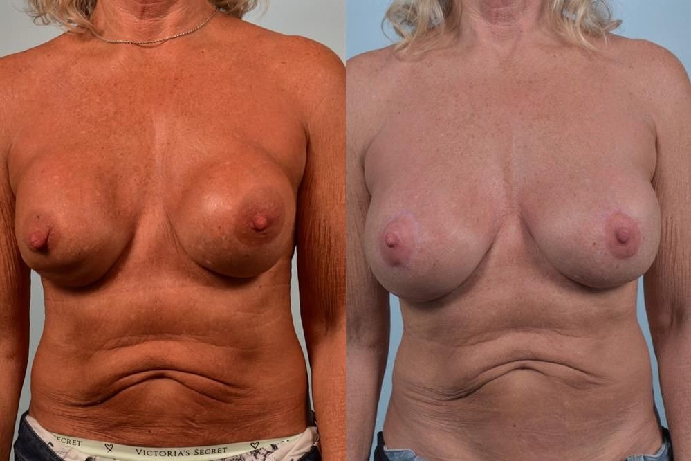 Breast Augmentation 5