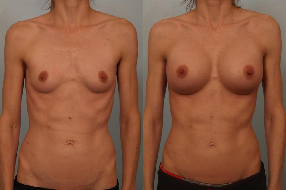 Breast Augmentation 50