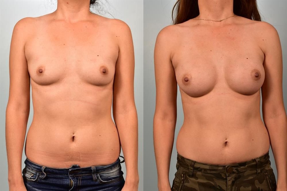 Breast Augmentation 51