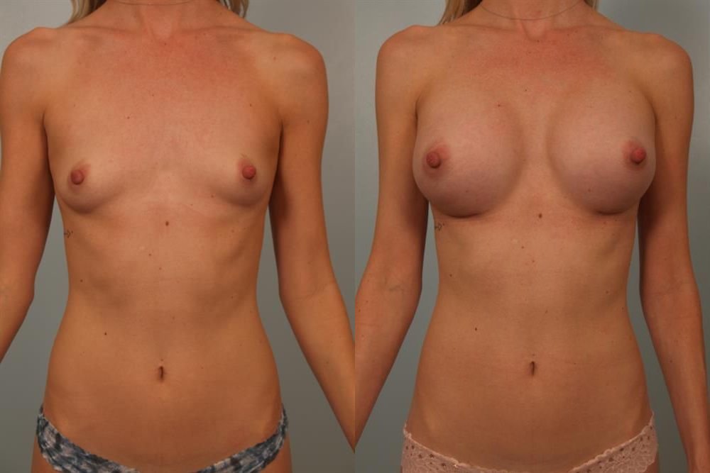 Breast Augmentation 52