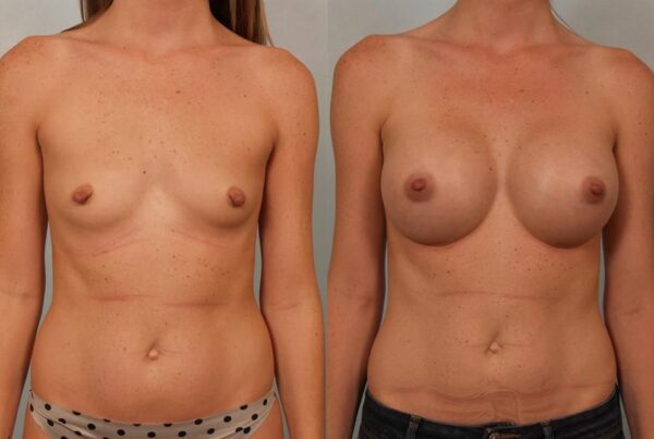 Breast Augmentation 54