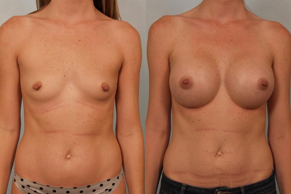 Breast Augmentation 54