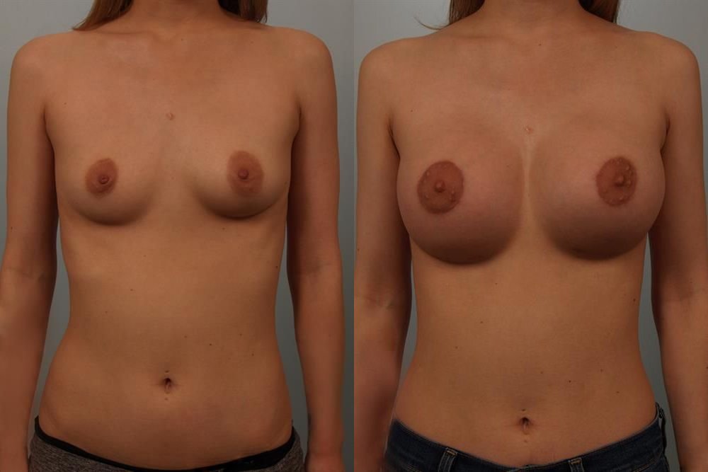 Breast Augmentation 55