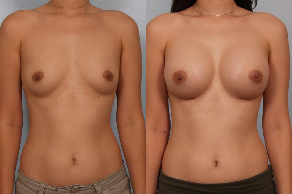 Breast Augmentation 56