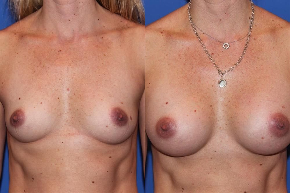 Breast Augmentation 57