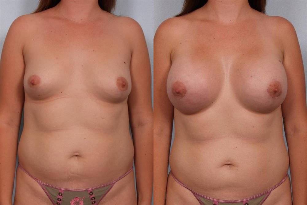 Breast Augmentation 58