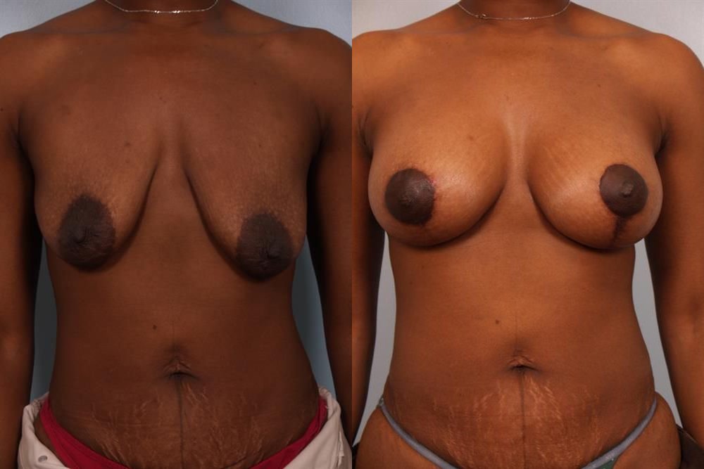 Breast Augmentation 59