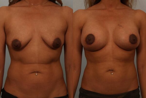 Breast Augmentation 6