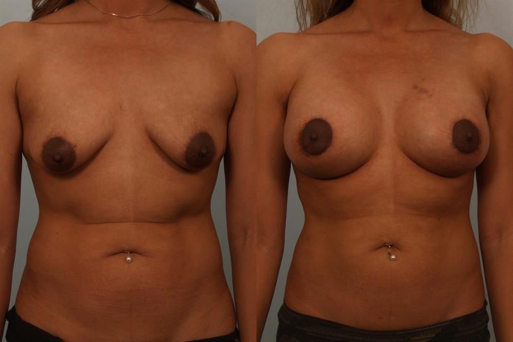 Breast Augmentation 6