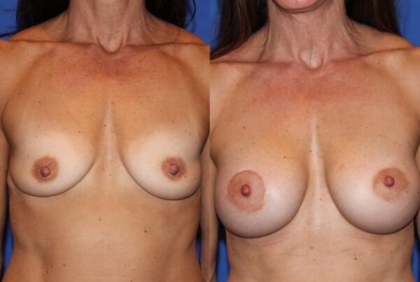 Breast Augmentation 60