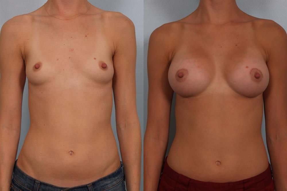 Breast Augmentation 61