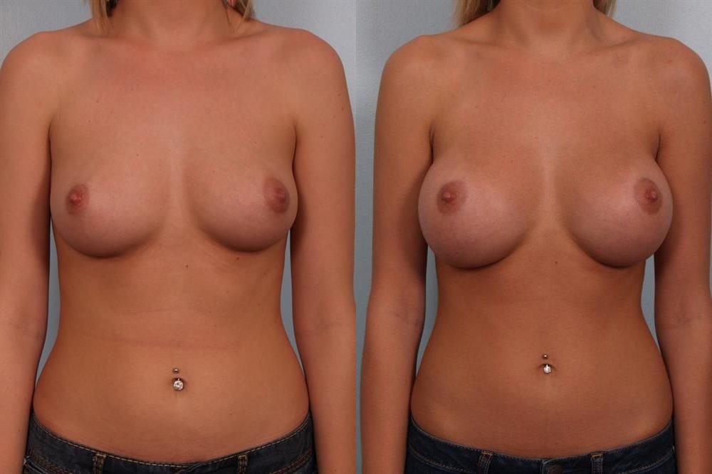 Breast Augmentation 62