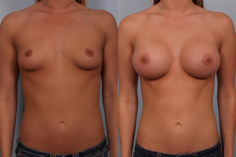 Breast Augmentation 63