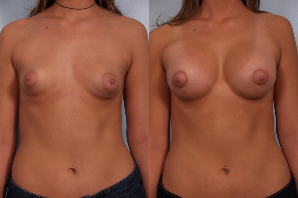 Breast Augmentation 65