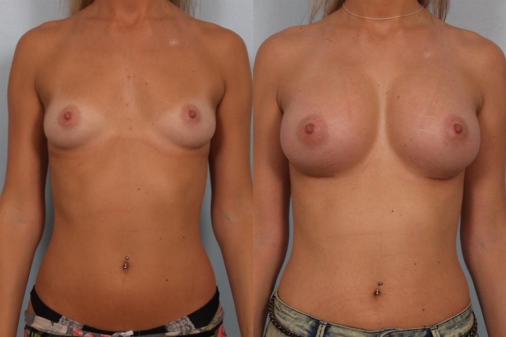 Breast Augmentation 67