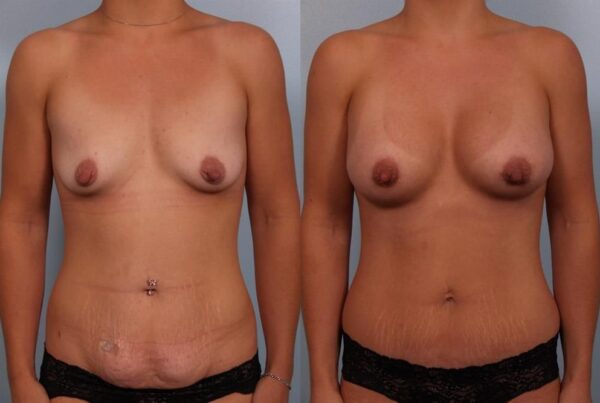 Breast Augmentation 68