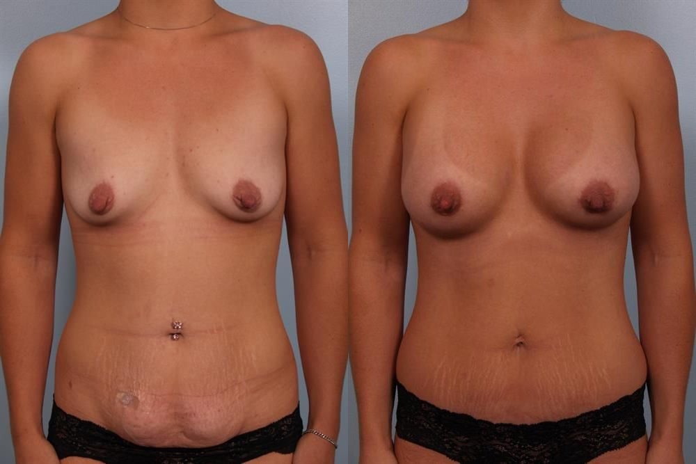 Breast Augmentation 68