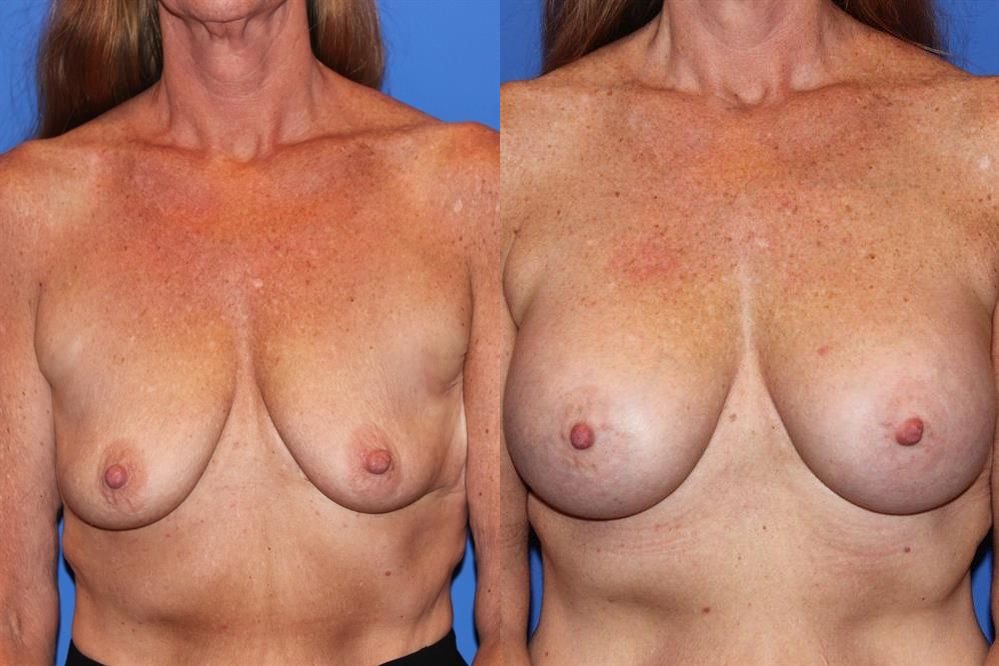 Breast Augmentation 69