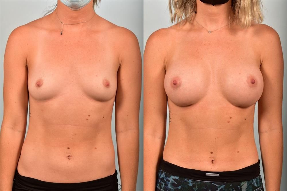 Breast Augmentation 7