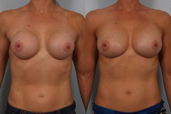 Breast Augmentation 70