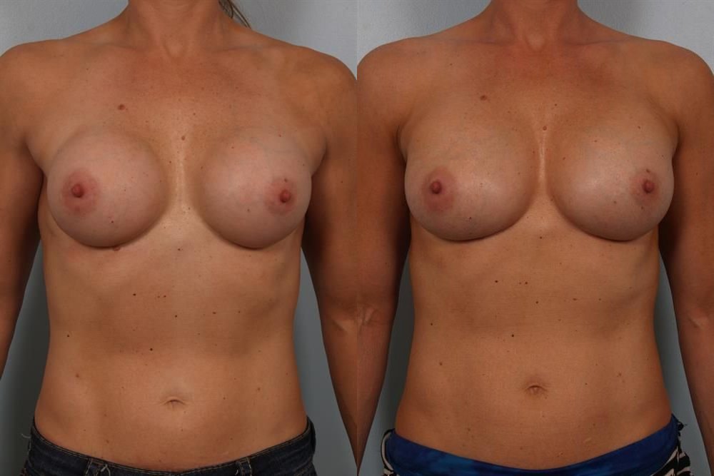 Breast Augmentation 70