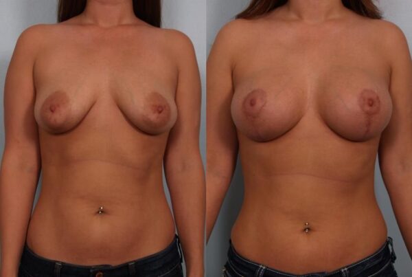 Breast Augmentation 71