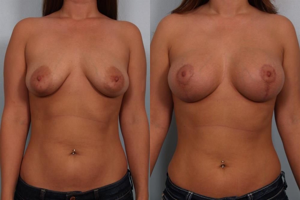 Breast Augmentation 71