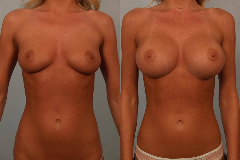 Breast Augmentation 72