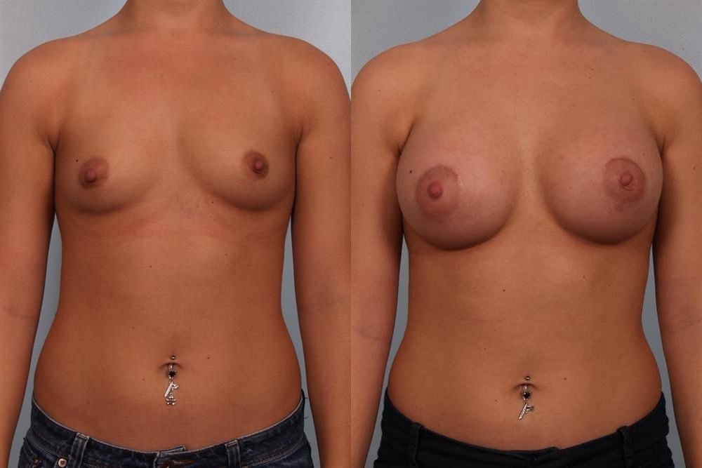 Breast Augmentation 73