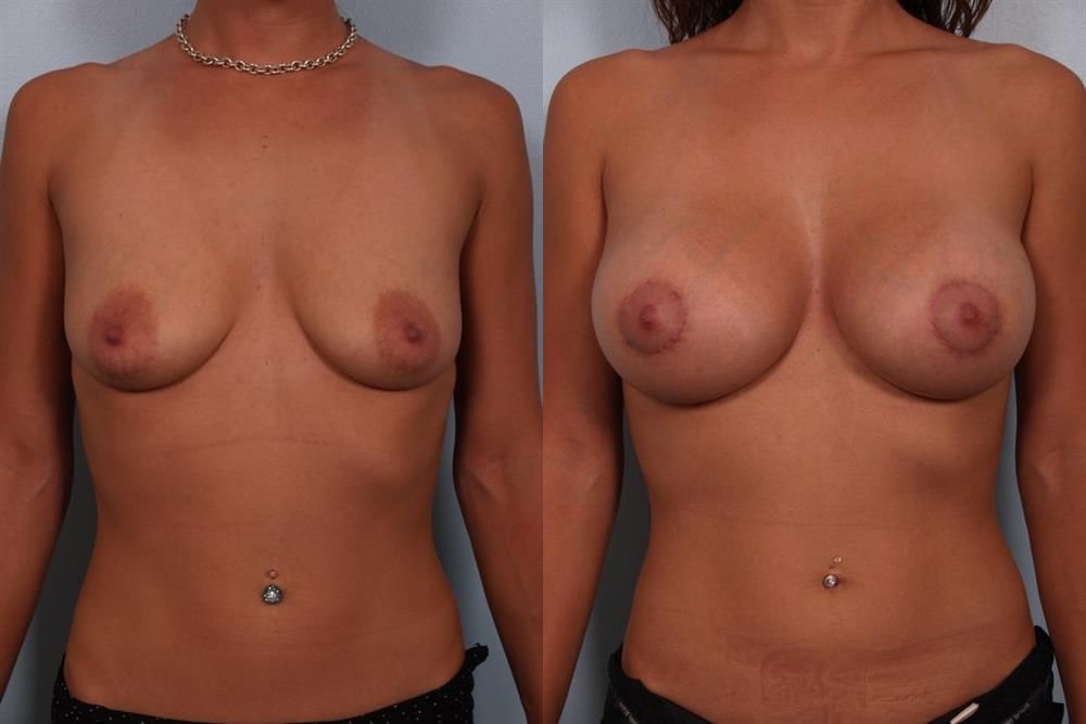 Breast Augmentation 74
