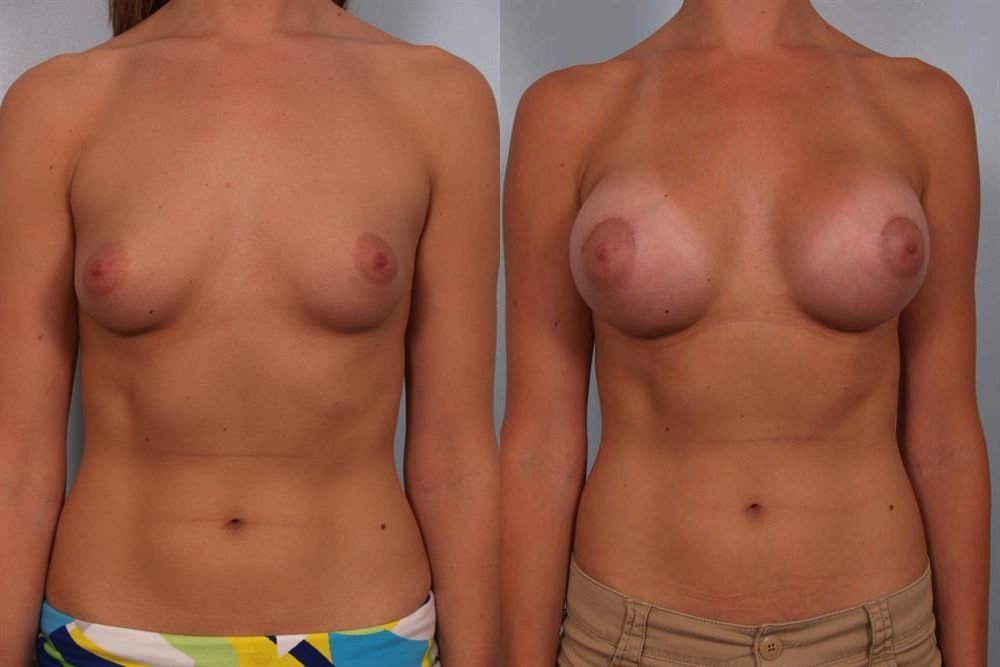Breast Augmentation 75