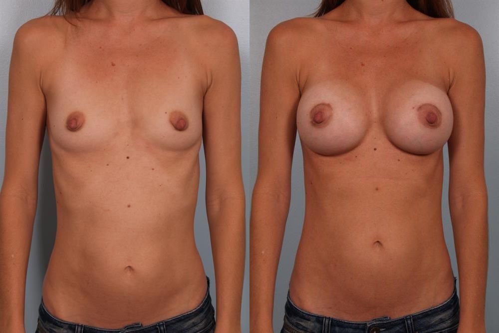 Breast Augmentation 76